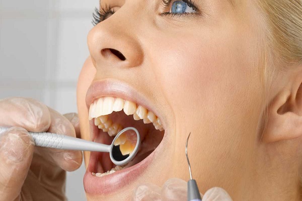 ¿Qué son las caries?
