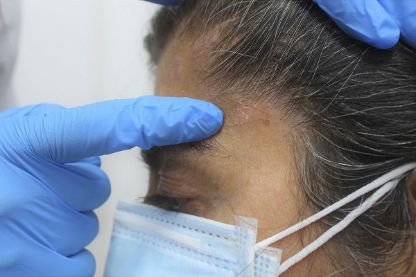 Covid-19: EsSalud advierte incremento de psoriasis por estrés durante la pandemia